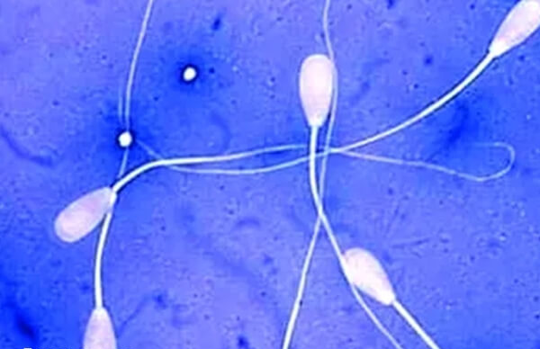 精子活力不好是不是只能做试管婴儿