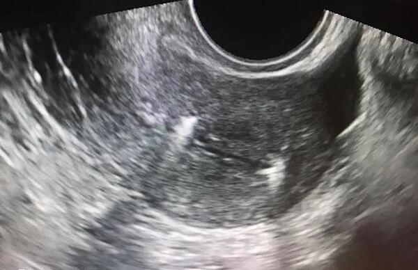 取卵后如何避免发生宫腔分离