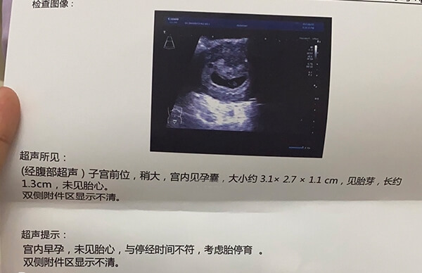 试管胎停育的前兆反应有哪些