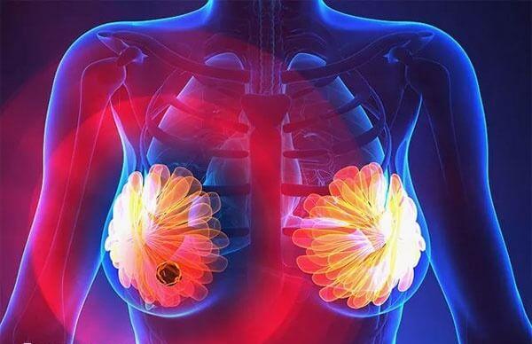 乳腺全切还能否做试管婴儿
