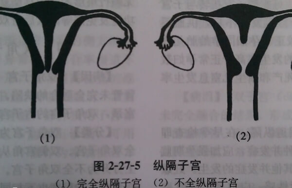 0.5厘米子宫纵隔怀试管双胎有没有成功的