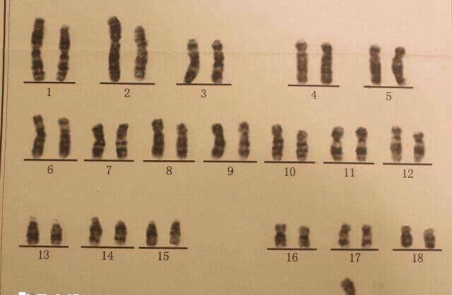 5号染色体三体是什么意思