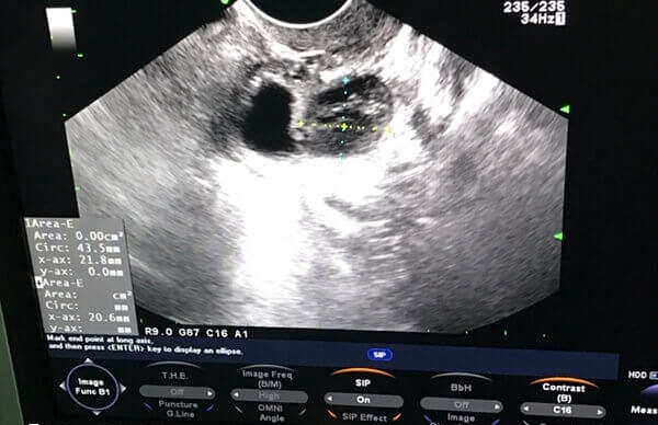 俄罗斯试管婴儿短方案过程是怎样的
