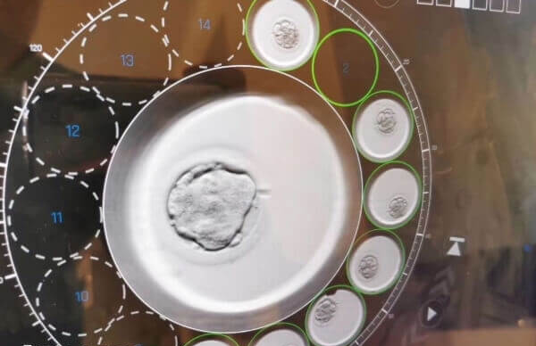 在长春做第二次试管的费用是多少