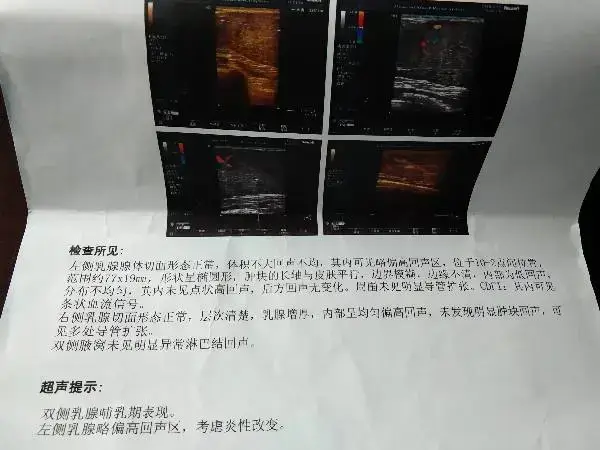 乳腺结节三类能否做试管婴儿