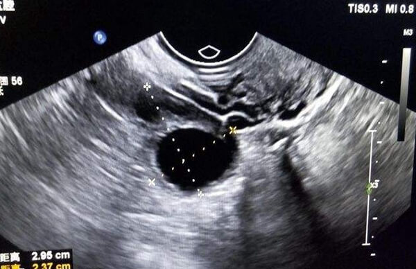 山西人工授精有哪些流程