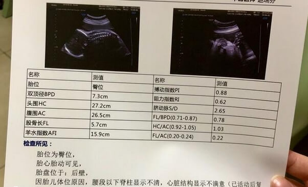 双胞胎小排畸多少周做最合适