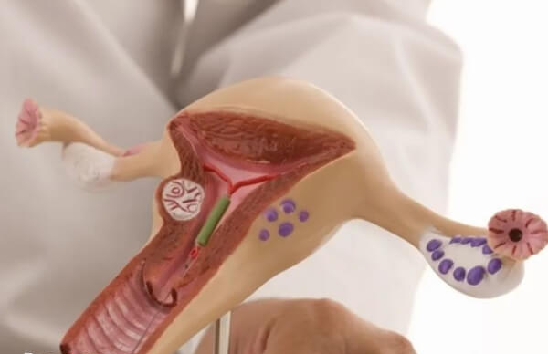 盆腔结核做试管能否成功