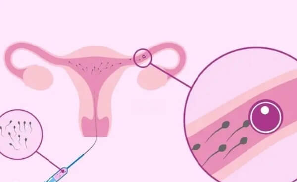 重庆供精人工授精的流程是什么