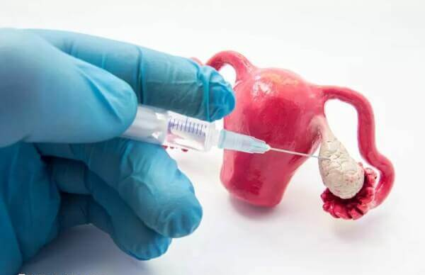 取卵后腹水能不能自愈